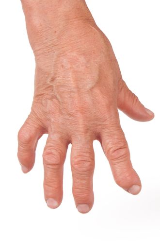 Congenital Hand Differences